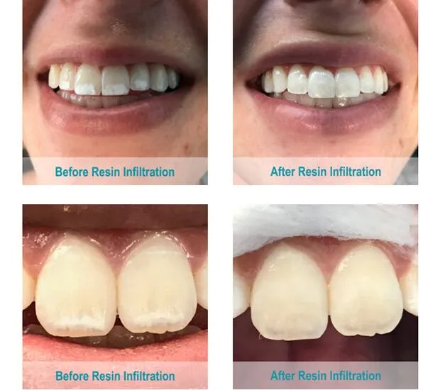 Icon resin infiltration treatment for white-spot lesions on a child’s teeth